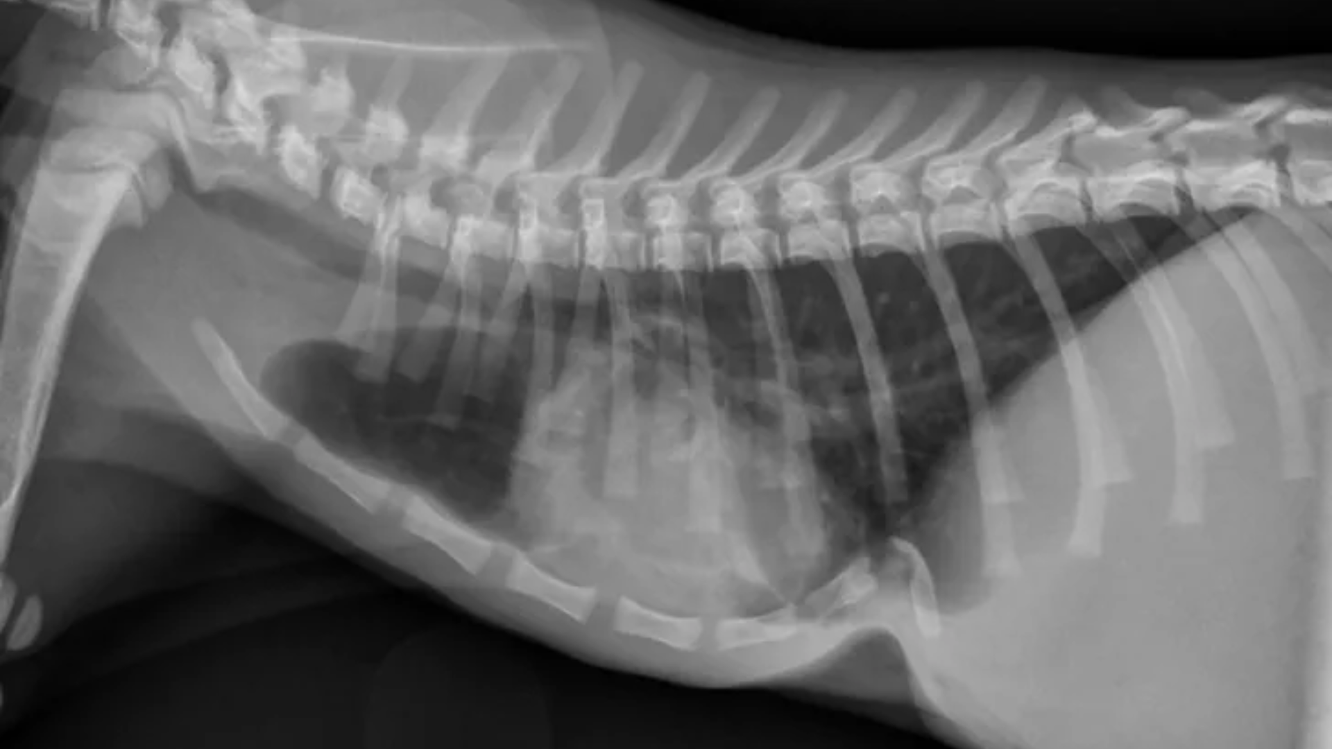 漏斗胸(Pectus Excavatum)